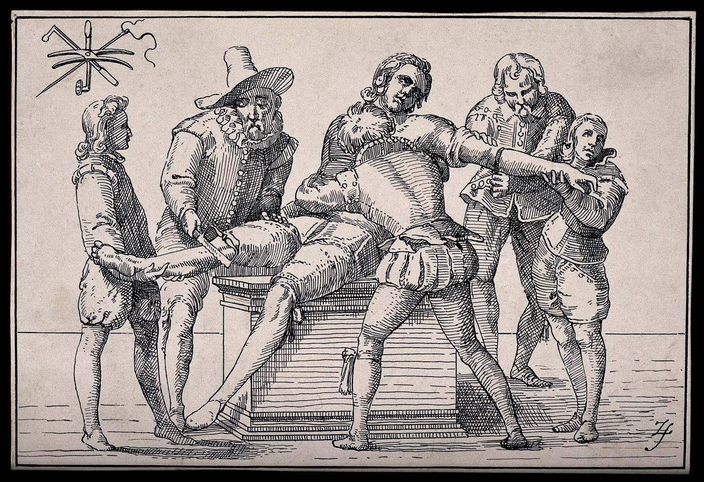 Gravura de 1597 com cirurgiões operando um paciente seguro por assistentes